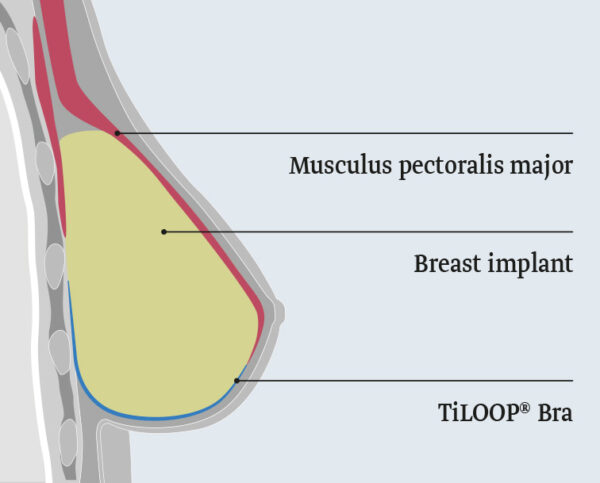 TiLOOP Bra extralight -kudostukiverkko