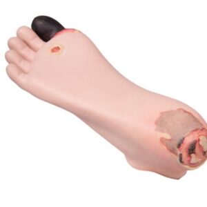 Diabetes jalan decubitus hoitomalli